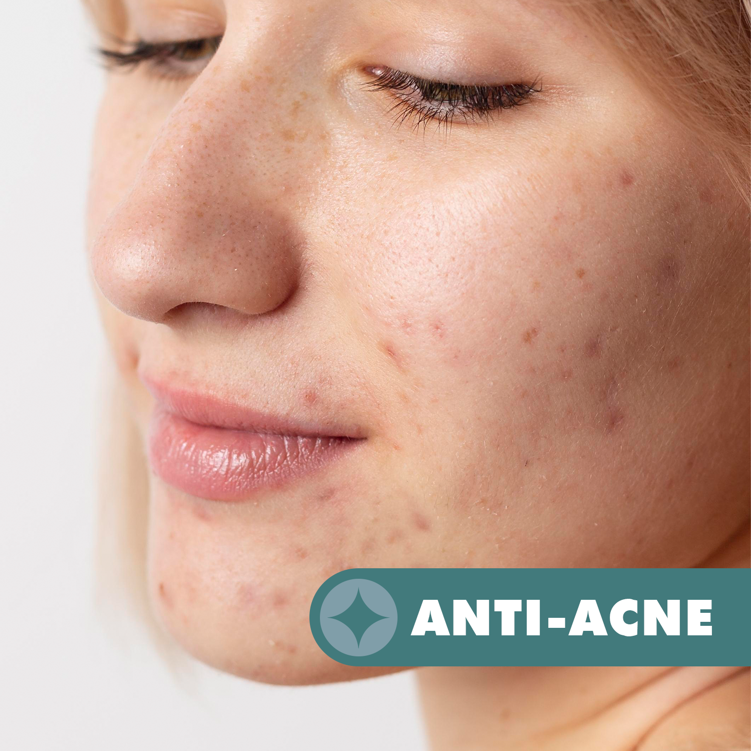 Anti-Acne