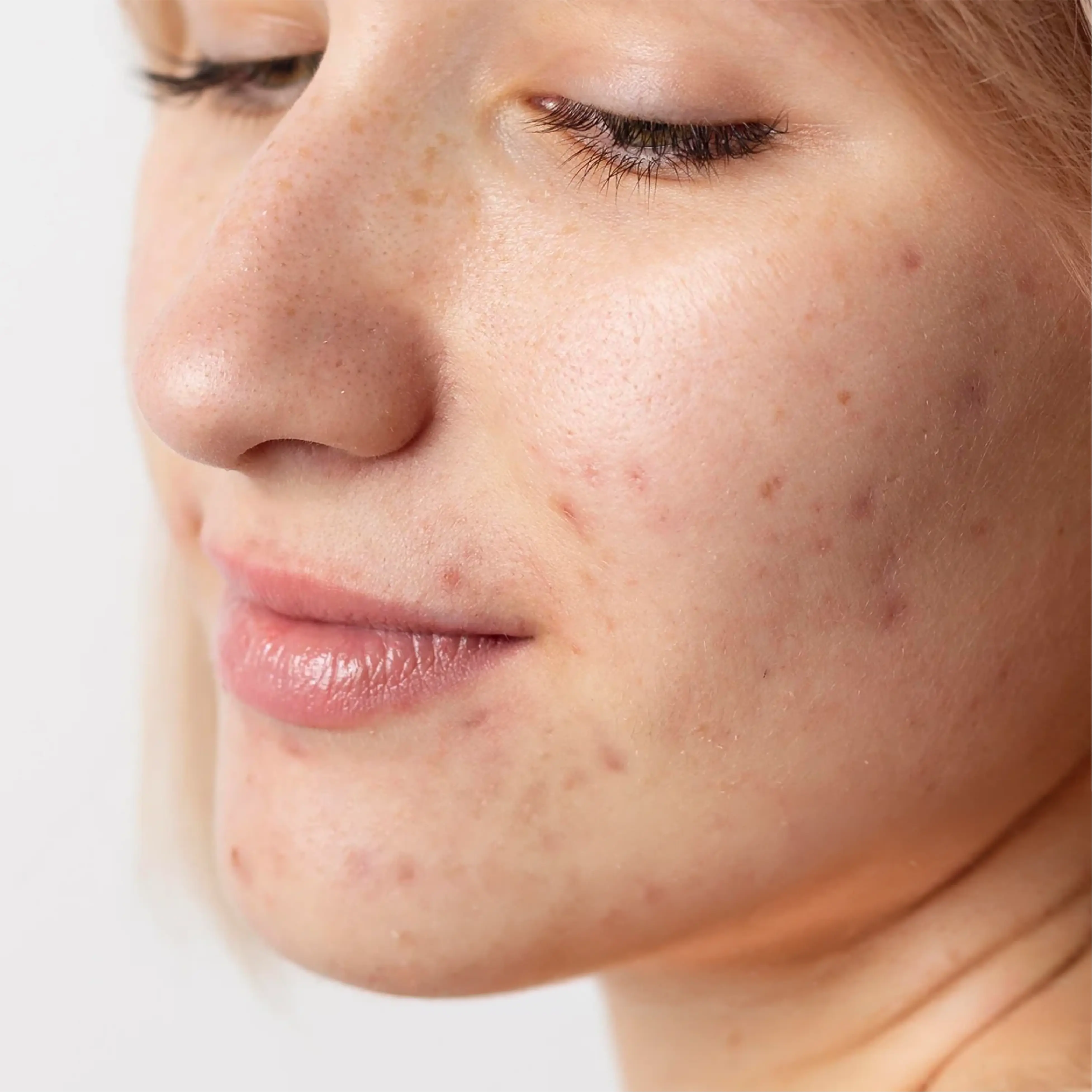 Anti-Acne