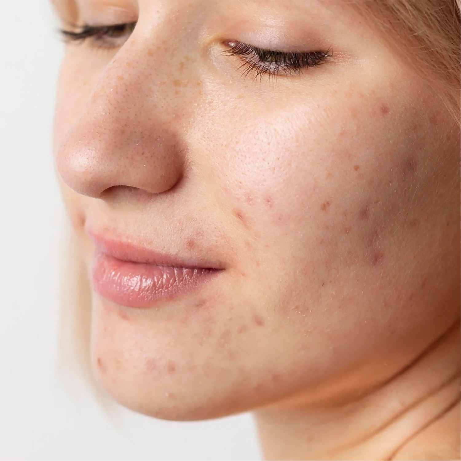 Anti-Acne