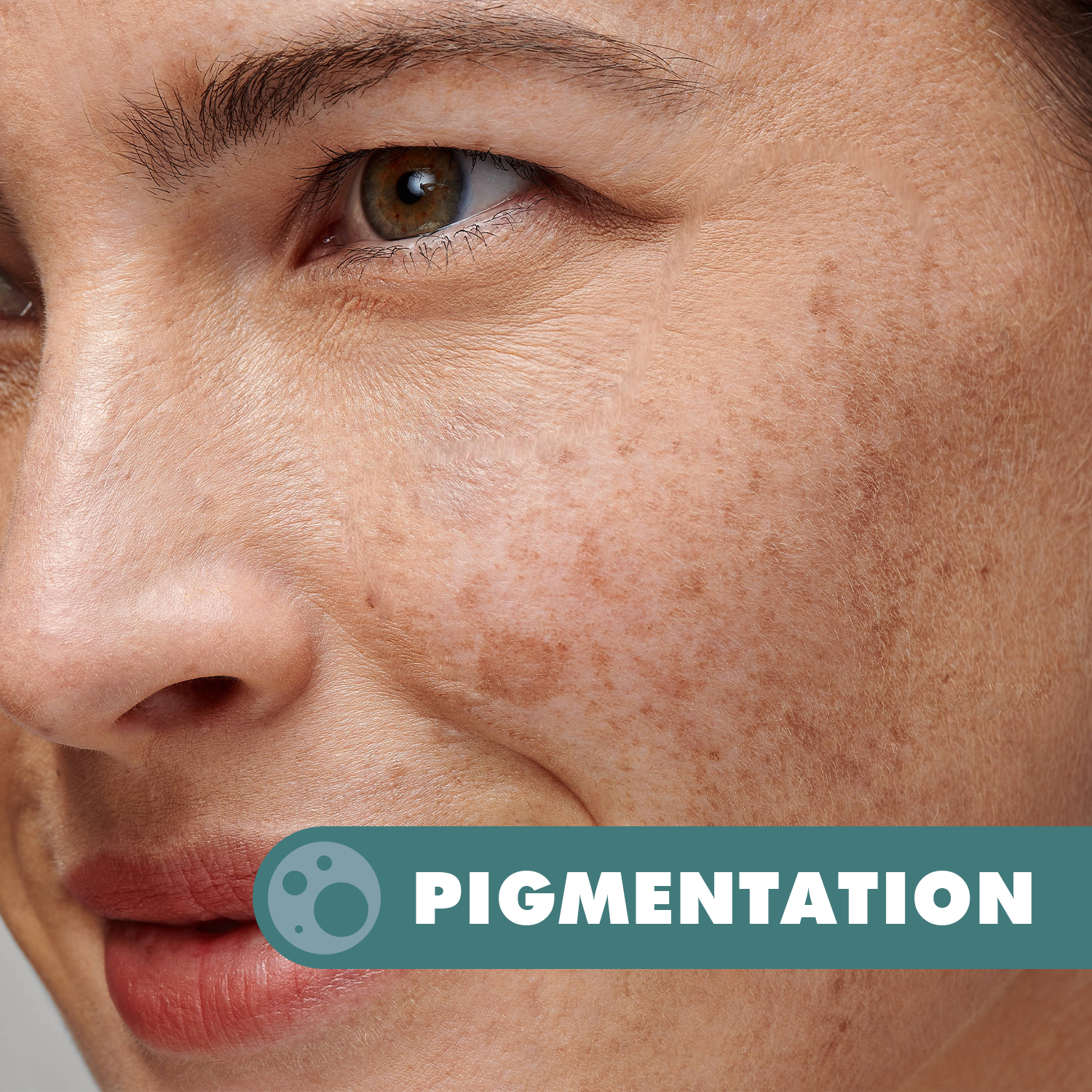 Pigmentation