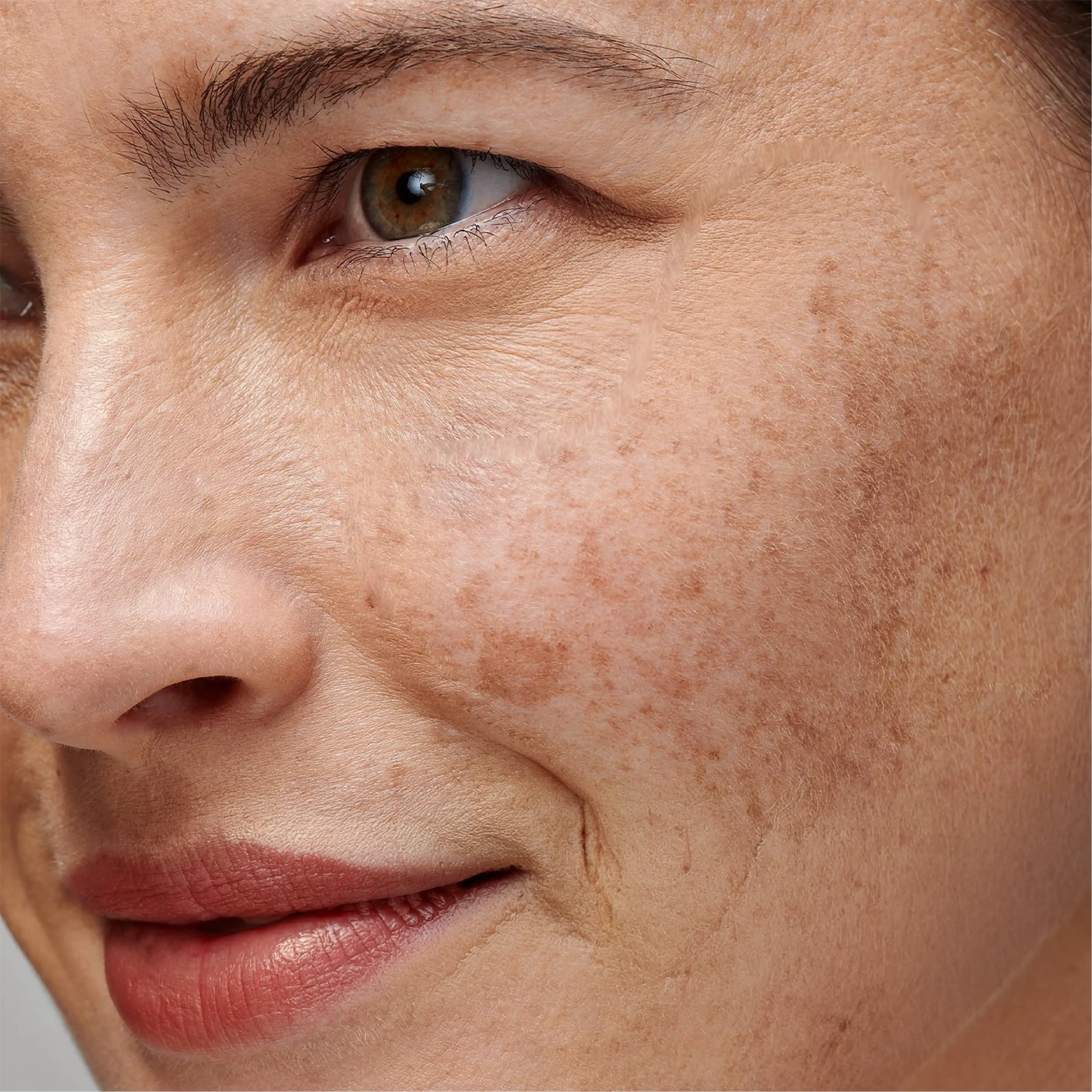 Pigmentation