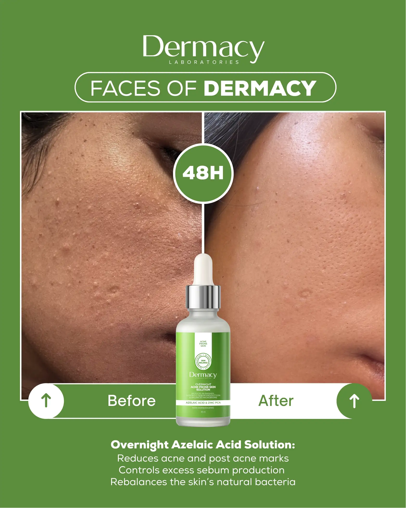 Overnight Azelaic Acid Solution 30ml