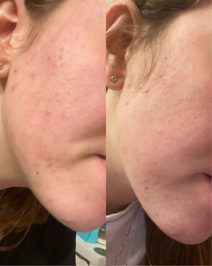 Pore Control Bundle