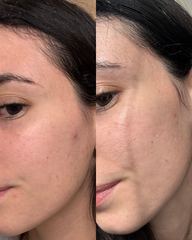 سيروم للبشرة المعرضة لحب الشباب بالنياسينامايد ٣٠ مل